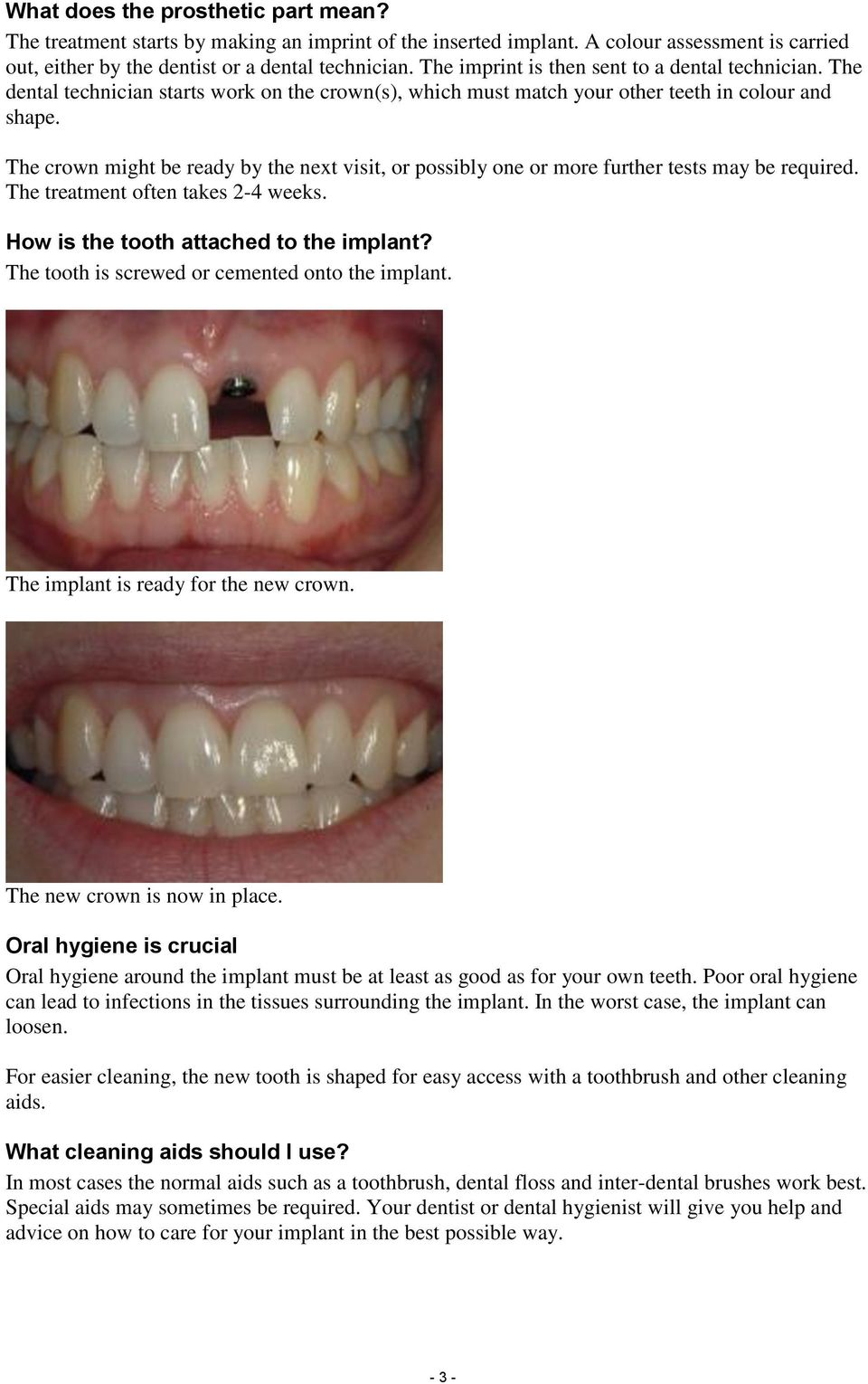 The crown might be ready by the next visit, or possibly one or more further tests may be required. The treatment often takes 2-4 weeks. How is the tooth attached to the implant?