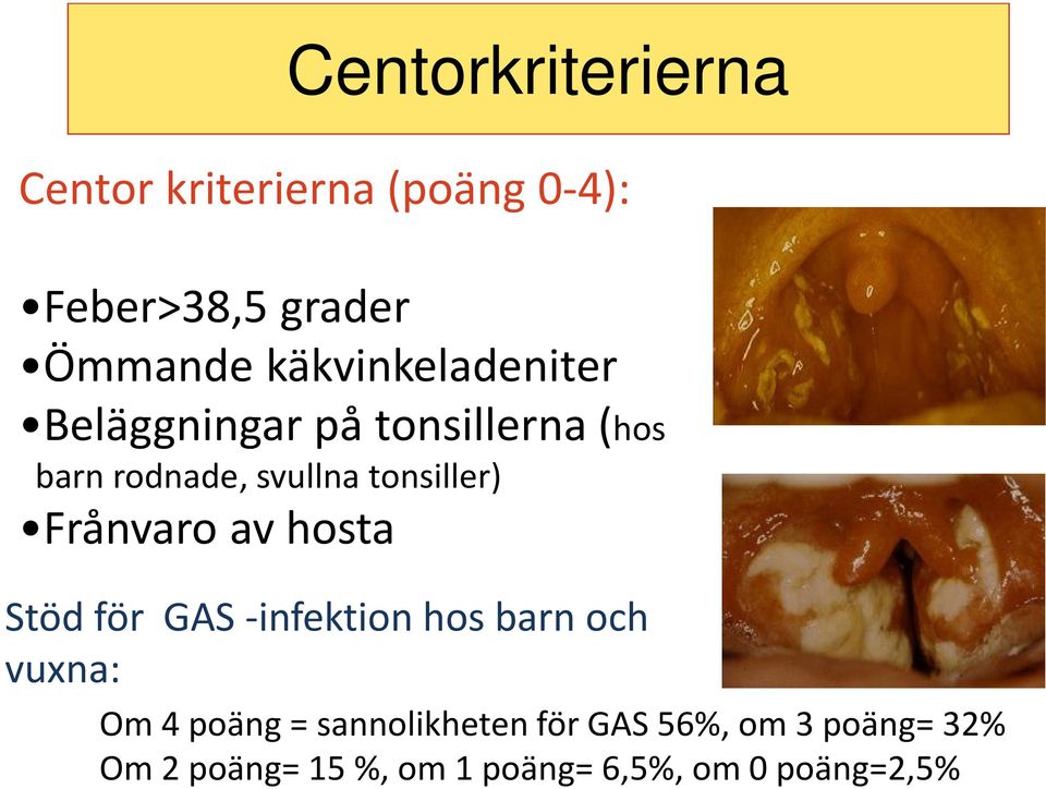 tonsiller) Frånvaro av hosta Stöd för GAS -infektion hos barn och vuxna: Om 4