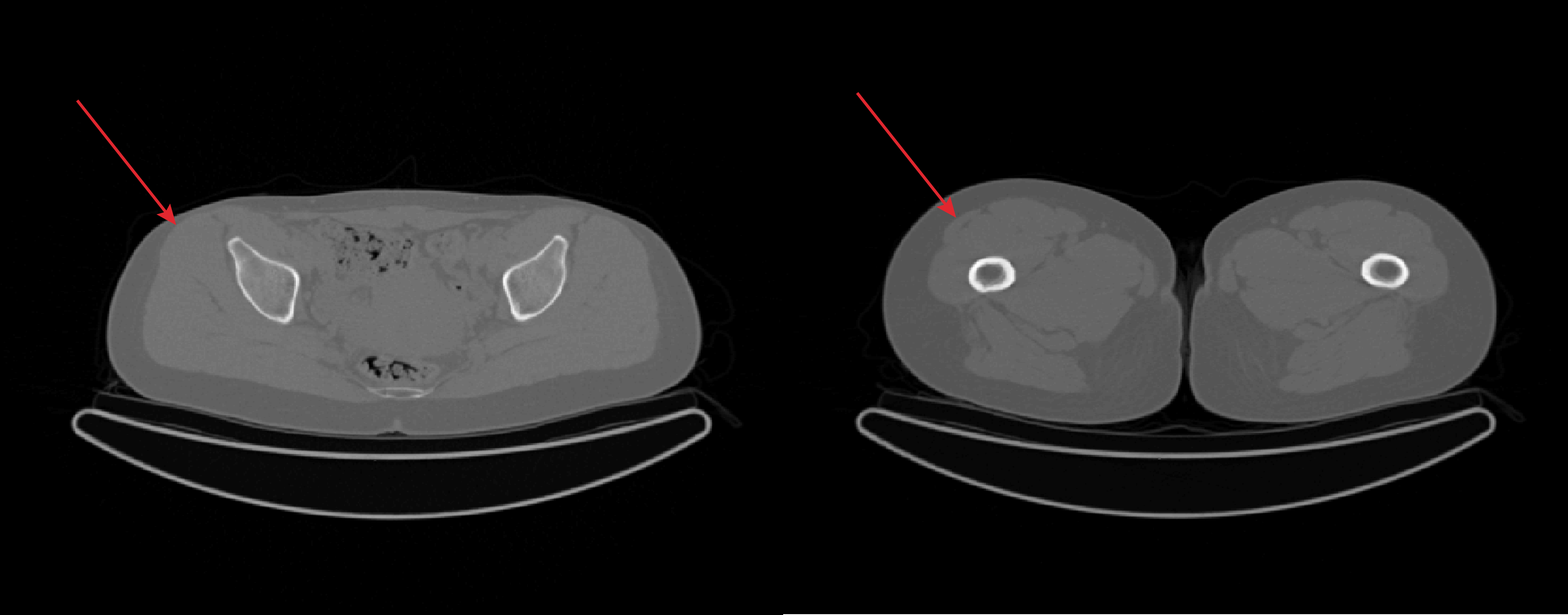 5. Resultat (a) MRT på en patients höft där tensor fasciae latae pekas ut med röda pilar i två olika skikt. Till vänster ses pelvis och till höger ses caput femoris [8].