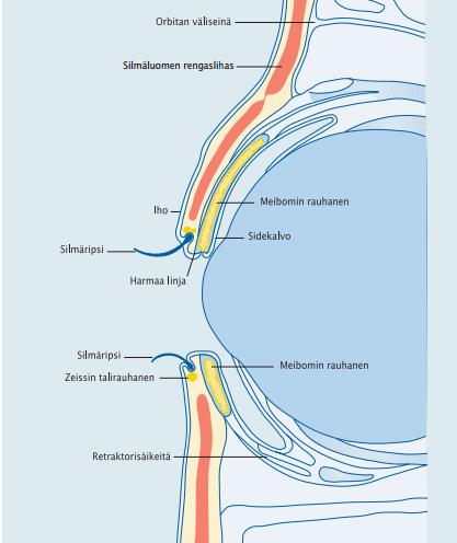 Inflammation i ögonlockskanten kan också påverka torra ögon En kroniskt inflammerad ögonlockskant kräver alltid långvarig och regelbunden vård för att läka.