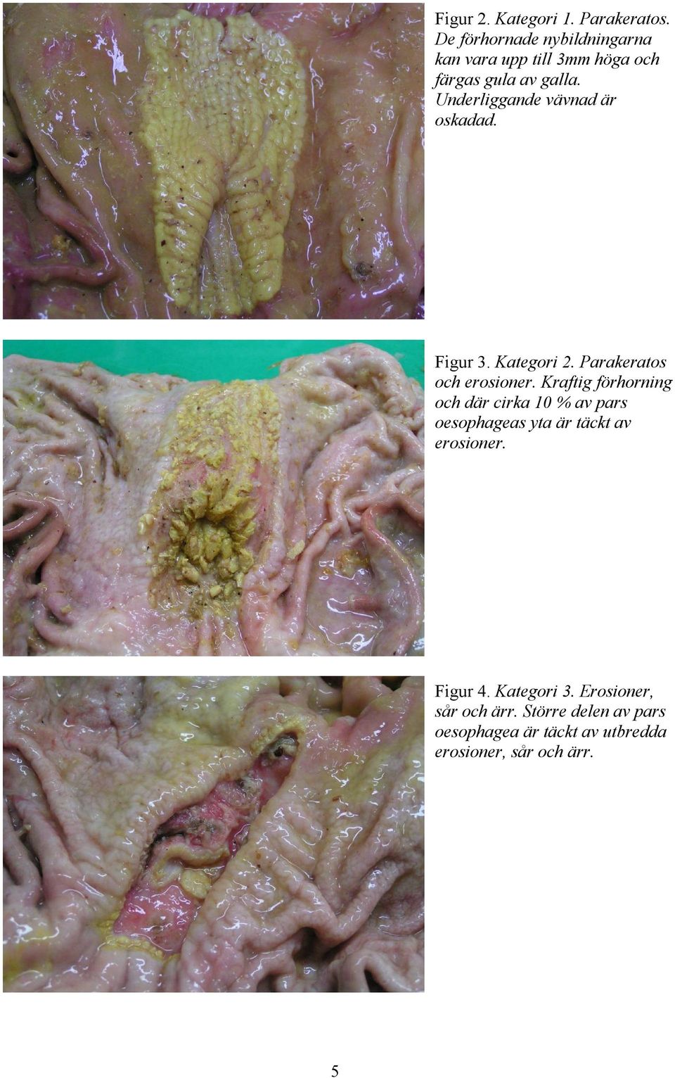 Underliggande vävnad är oskadad. Figur 3. Kategori 2. Parakeratos och erosioner.