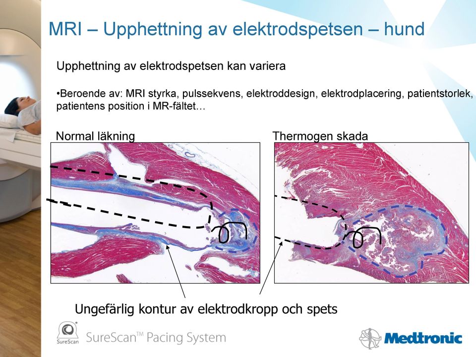 elektroddesign, elektrodplacering, patientstorlek, patientens