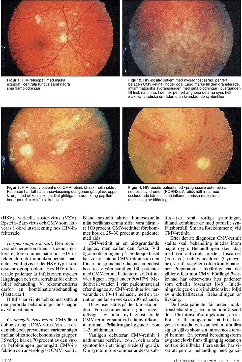 I de mer perifert angripna delarna syns helt inaktiva, atrofiska områden utan kvarstående synfunktion. Figur 3. HIV-positiv patient med CMV-retinit, kliniskt helt inaktiv.