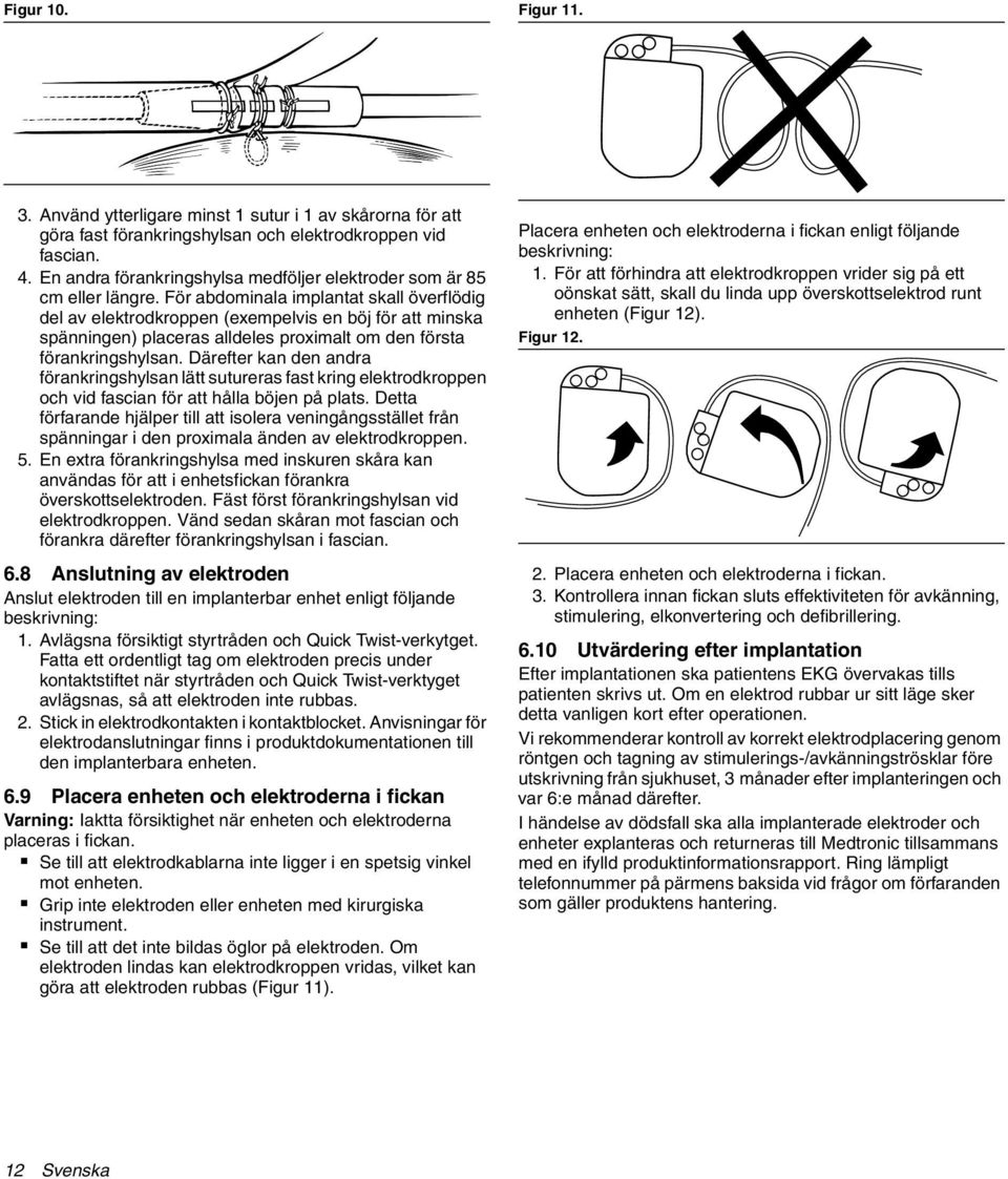 För abdominala implantat skall överflödig del av elektrodkroppen (exempelvis en böj för att minska spänningen) placeras alldeles proximalt om den första förankringshylsan.