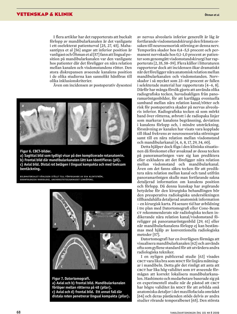 visdomstndens rötter. Den stor diskrepnsen vseende knlens position i de olik studiern kn snnolikt hänförs till olik inklusionskriterier. Även om inidensen v postopertiv dysestesi Figur 6. CBCT-ilder.