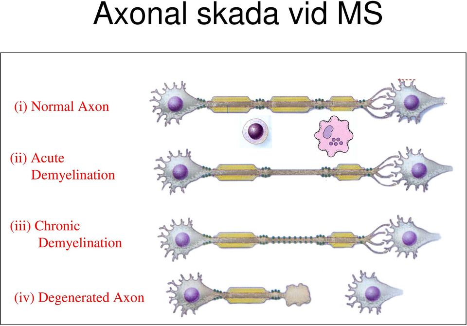 Demyelination (iii) Chronic