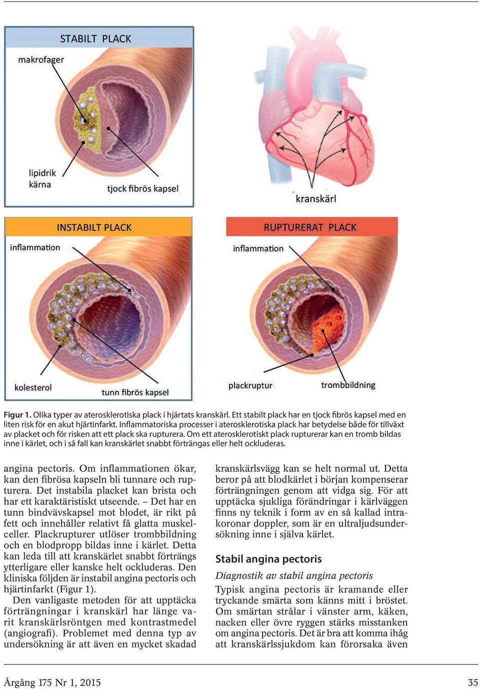 Om ett aterosklerotiskt plack rupturerar kan en tromb bildas inne i kärlet, och i så fall kan kranskärlet snabbt förträngas eller helt ockluderas. angina pectoris.