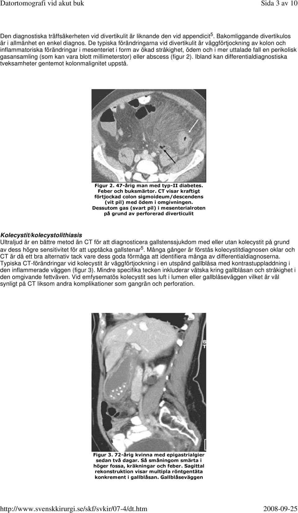 gasansamling (som kan vara blott millimeterstor) eller abscess (figur 2). Ibland kan differentialdiagnostiska tveksamheter gentemot kolonmalignitet uppstå. Figur 2. 47-årig man med typ-ii diabetes.