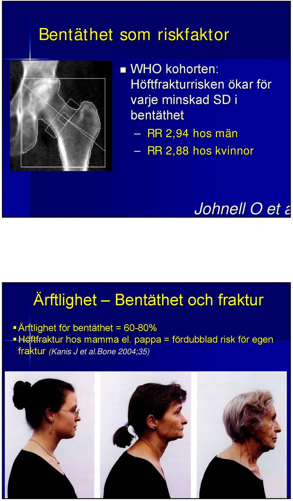 Ärftlighet Bentäthet thet och fraktur Ärftlighet för f r bentäthet thet = 60-80%