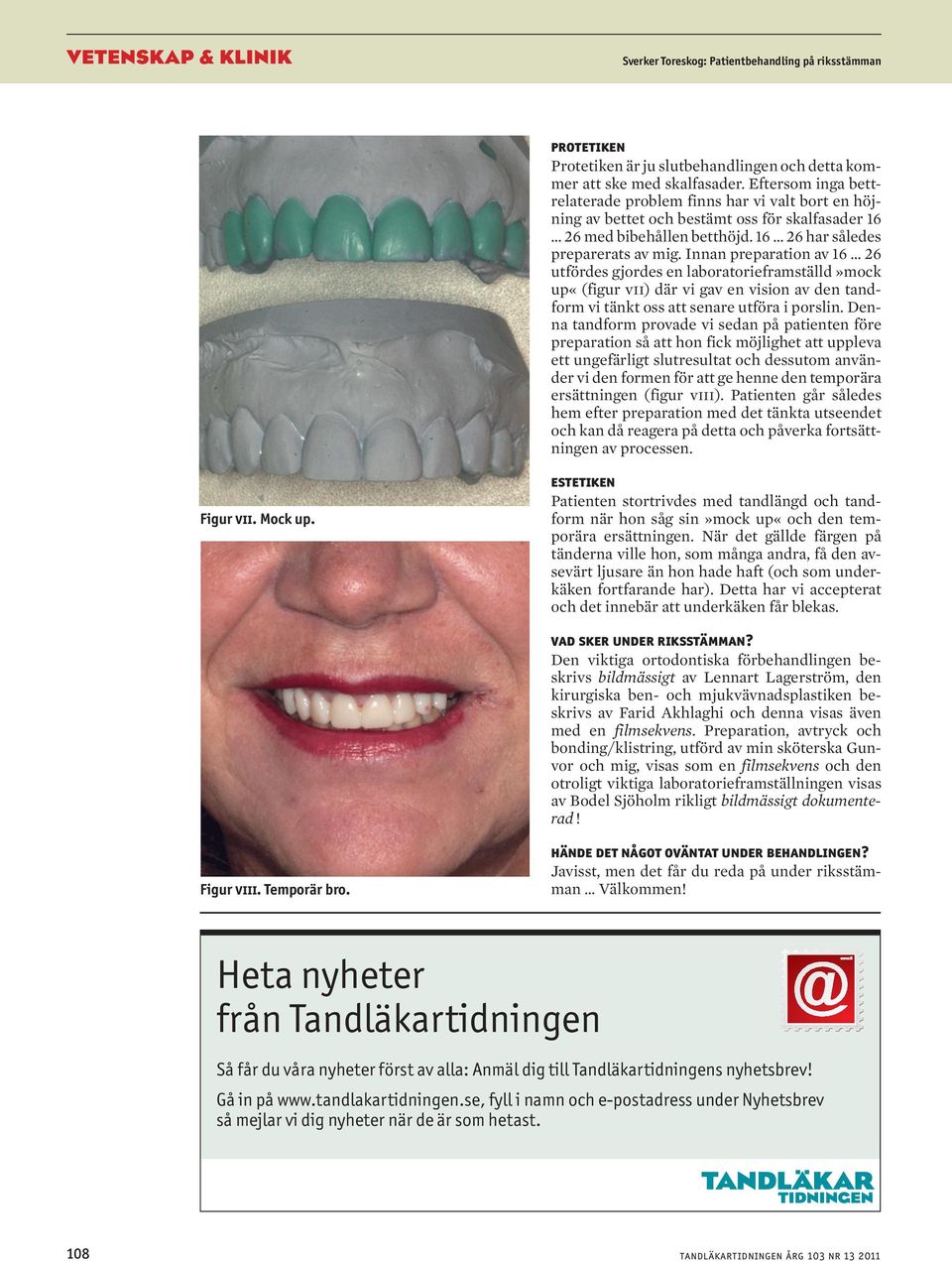 Innan preparation av 16 26 utfördes gjordes en laboratorieframställd»mock up«(figur vii) där vi gav en vision av den tandform vi tänkt oss att senare utföra i porslin.