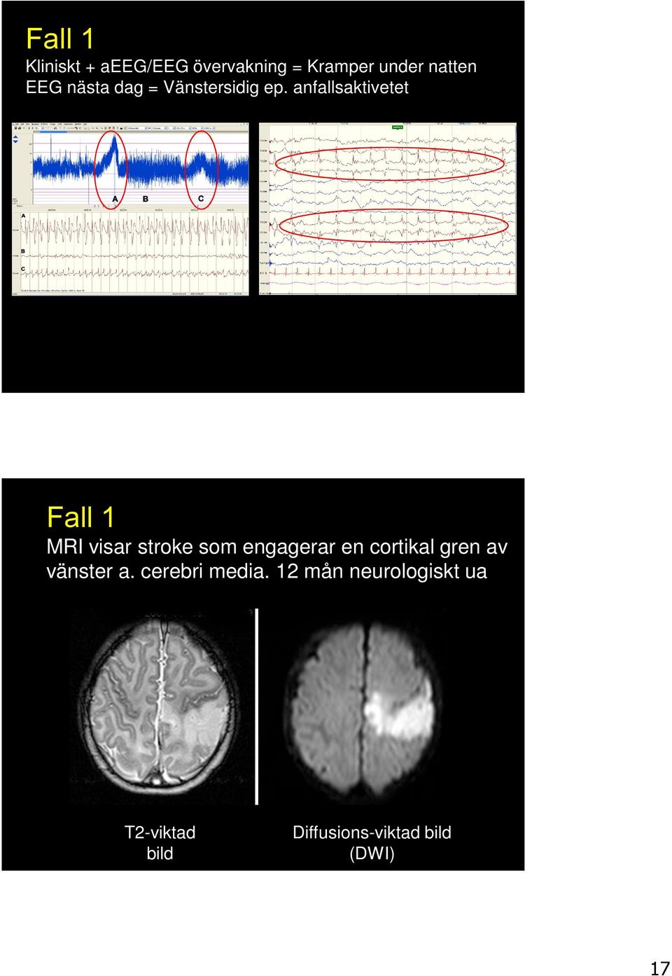anfallsaktivetet Fall 1 MRI visar stroke som engagerar en cortikal