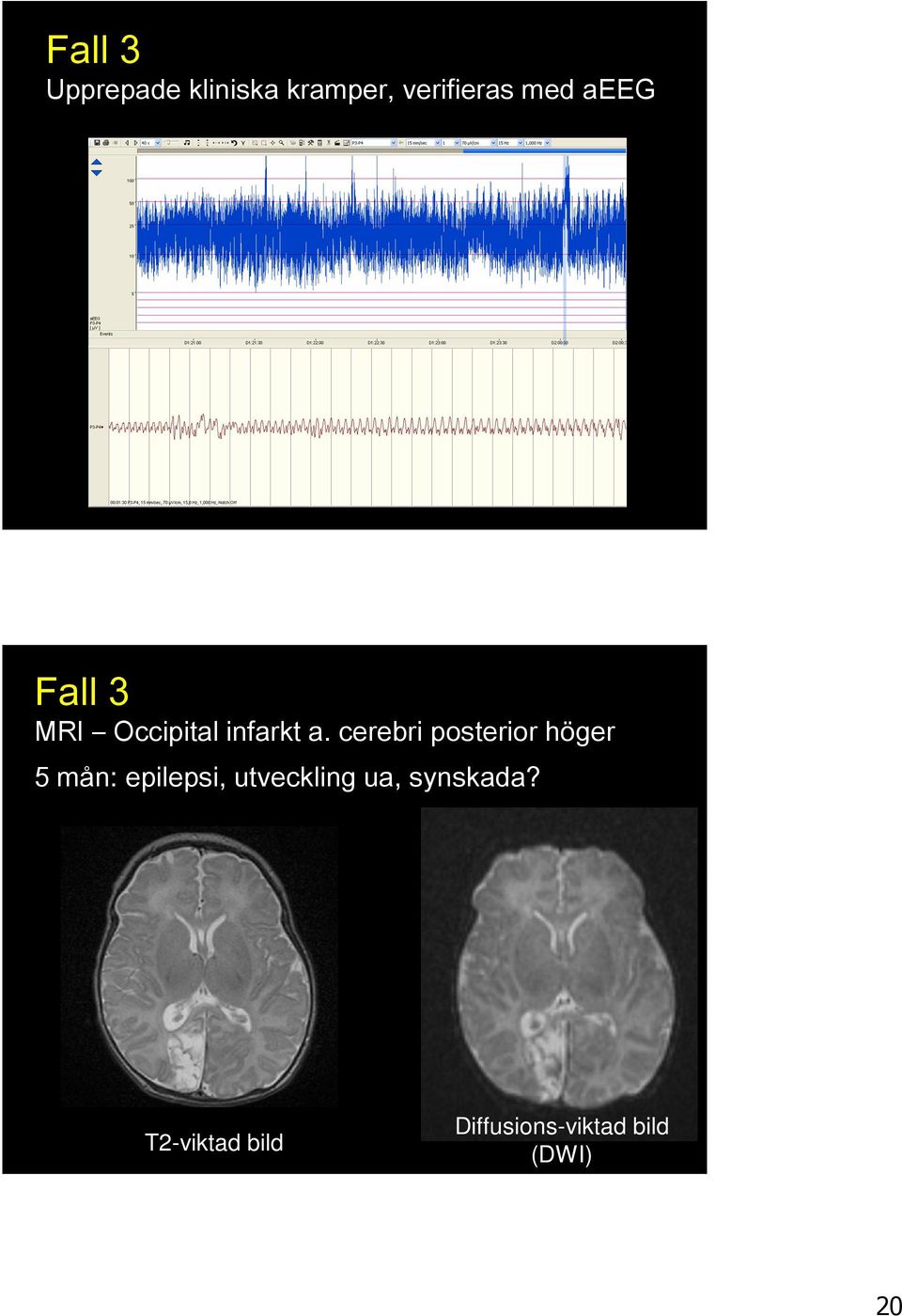 cerebri posterior höger 5 mån: epilepsi,