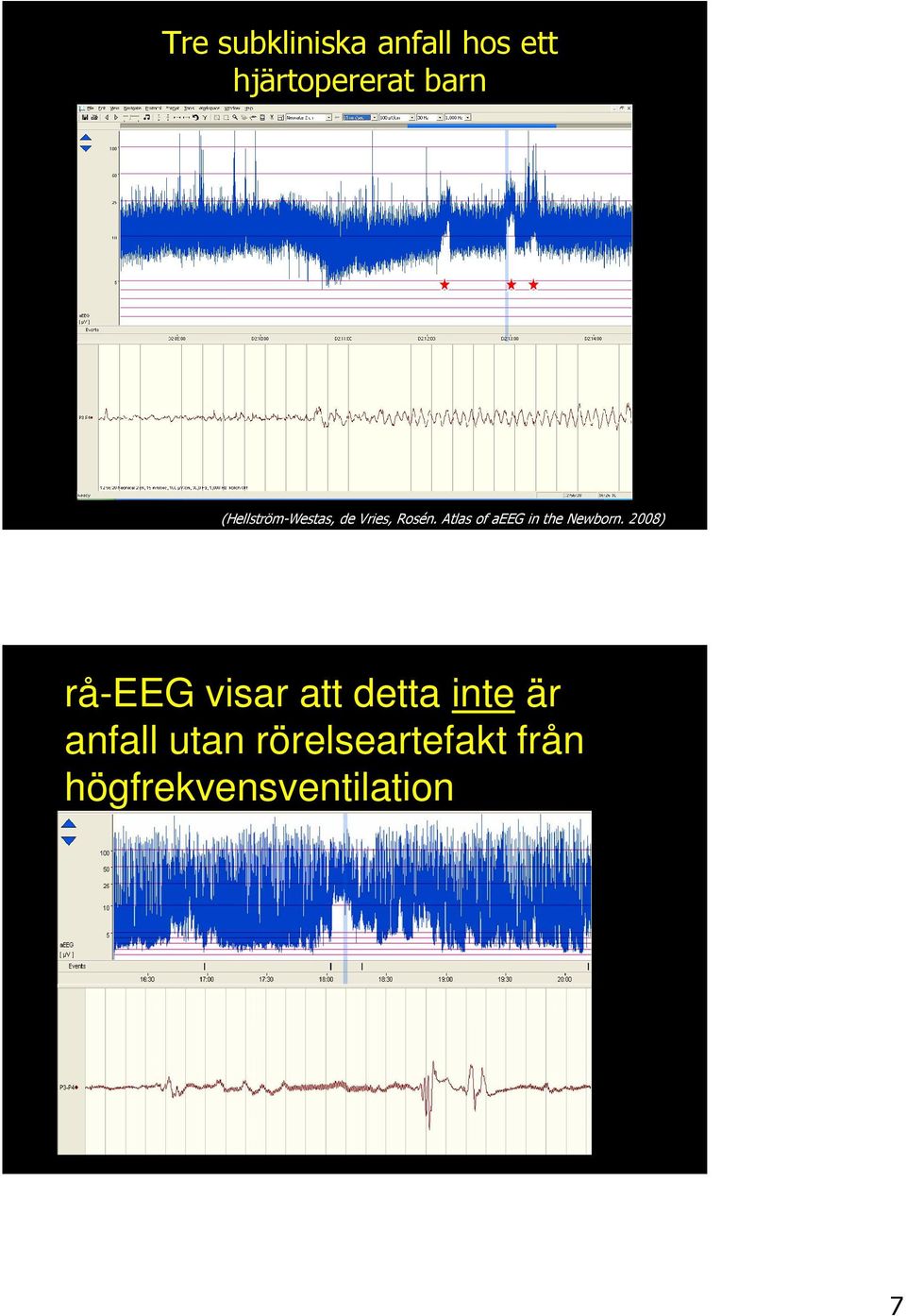 Atlas of aeeg in the Newborn.