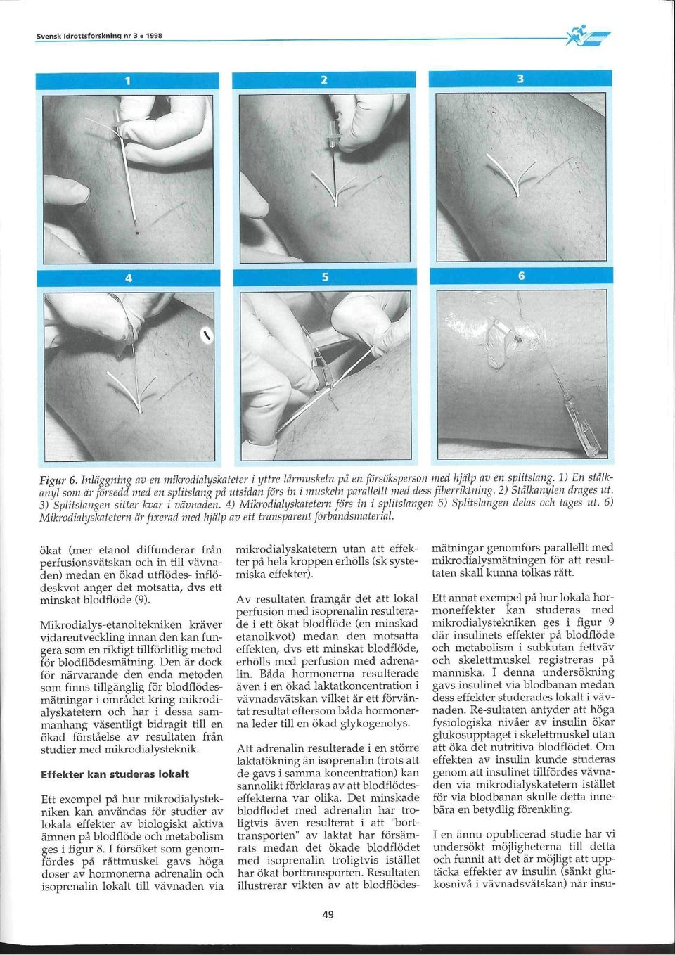 4) Mikrodzafyskafefern /Örs in i spfifsfangen 5) Spfifsfangen defas ocfi fages nf. 6) Mikrodiafys&afetern dr/izerad med fz/dfp av eff transparent/örbandsmaferiaf.