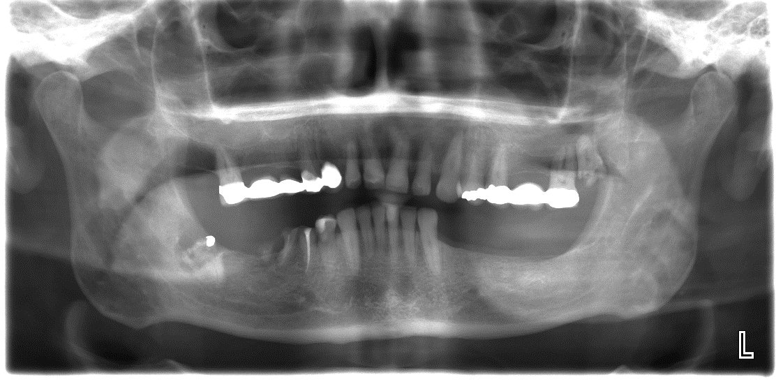 Underkäken: Mandibularkanalens superiora begränsning Foramen