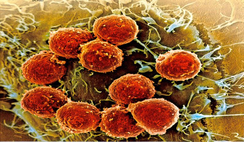 Vetenskaplig bakgrund Proof-of-Principle i humana cancerceller RhoC-specifika mördarceller eliminerar cancerceller.