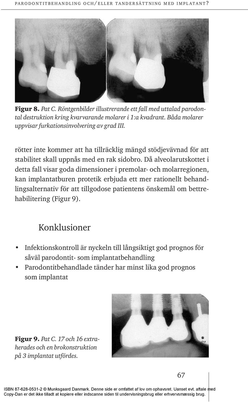 Då alveolarutskottet i detta fall visar goda dimensioner i premolar- och molarregionen, kan implantatburen protetik erbjuda ett mer rationellt behandlingsalternativ för att tillgodose patientens