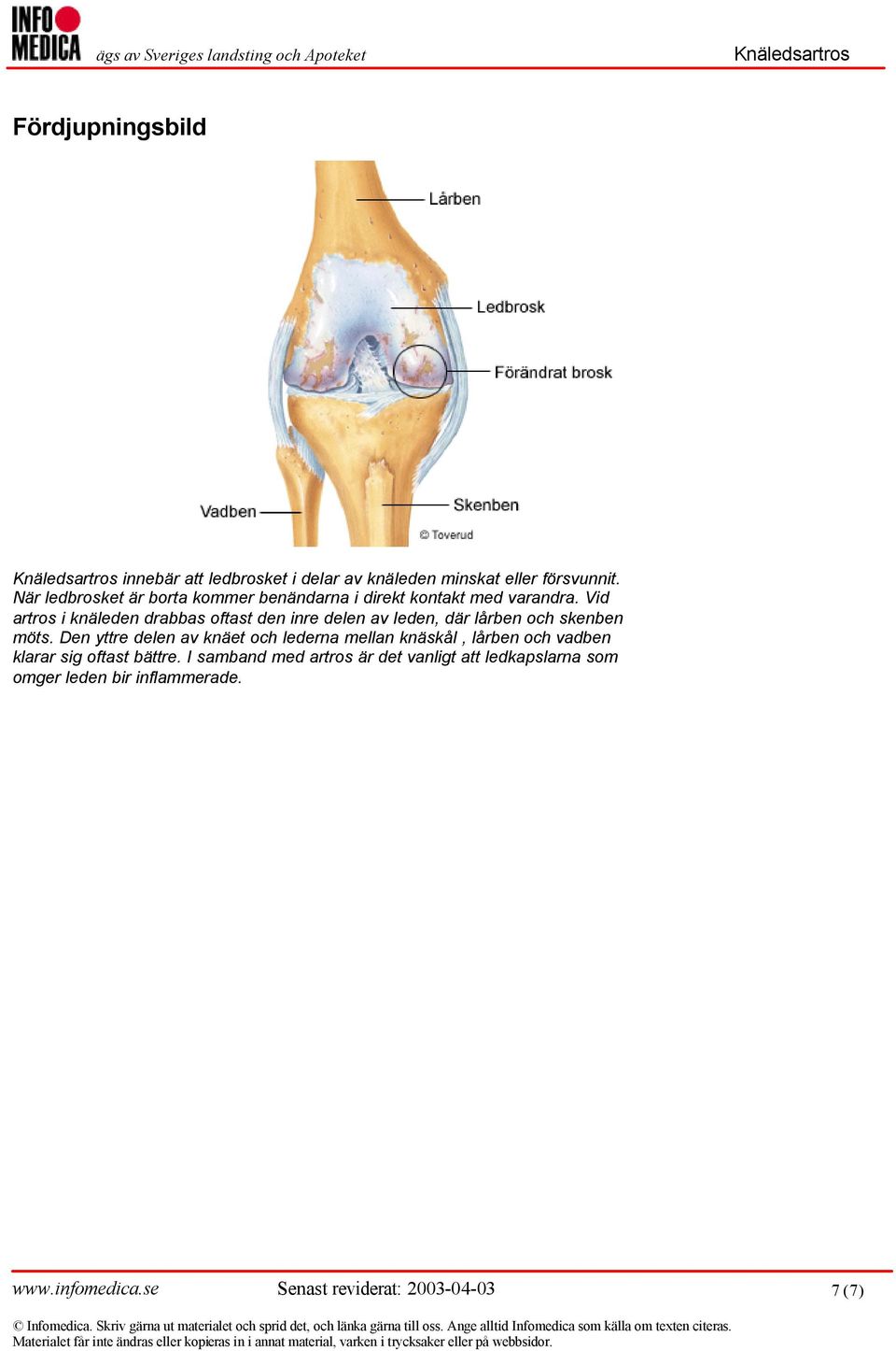 Vid artros i knäleden drabbas oftast den inre delen av leden, där lårben och skenben möts.