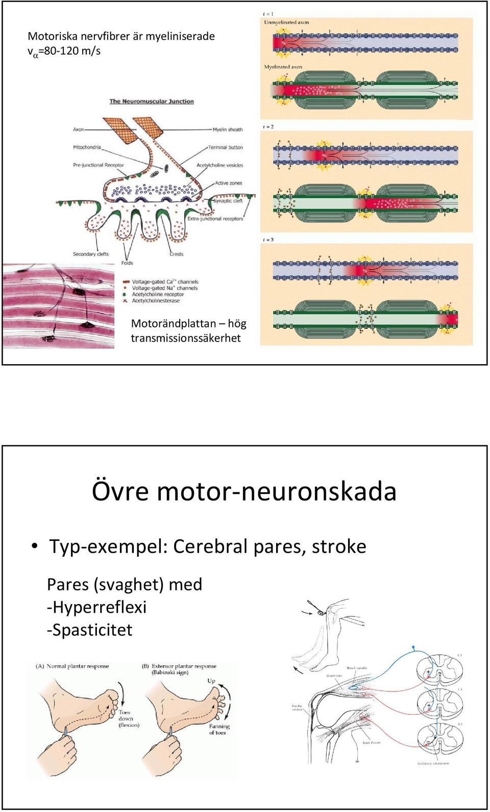 motor-neuronskada Typ-exempel: Cerebral pares,