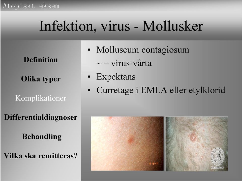 contagiosum ~ virus-vårta