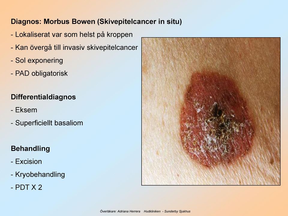 Sol exponering - PAD obligatorisk Differentialdiagnos - Eksem -