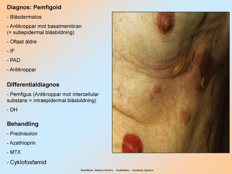 Differentialdiagnos - Pemfigus (Antikroppar mot intercellular substans =