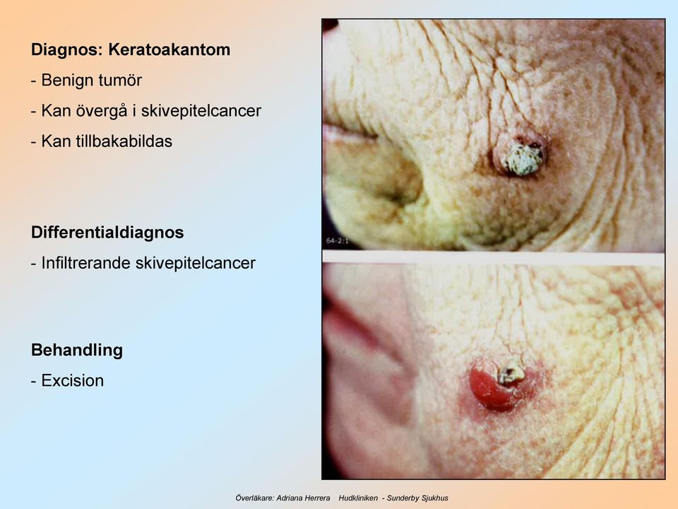 tillbakabildas Differentialdiagnos -