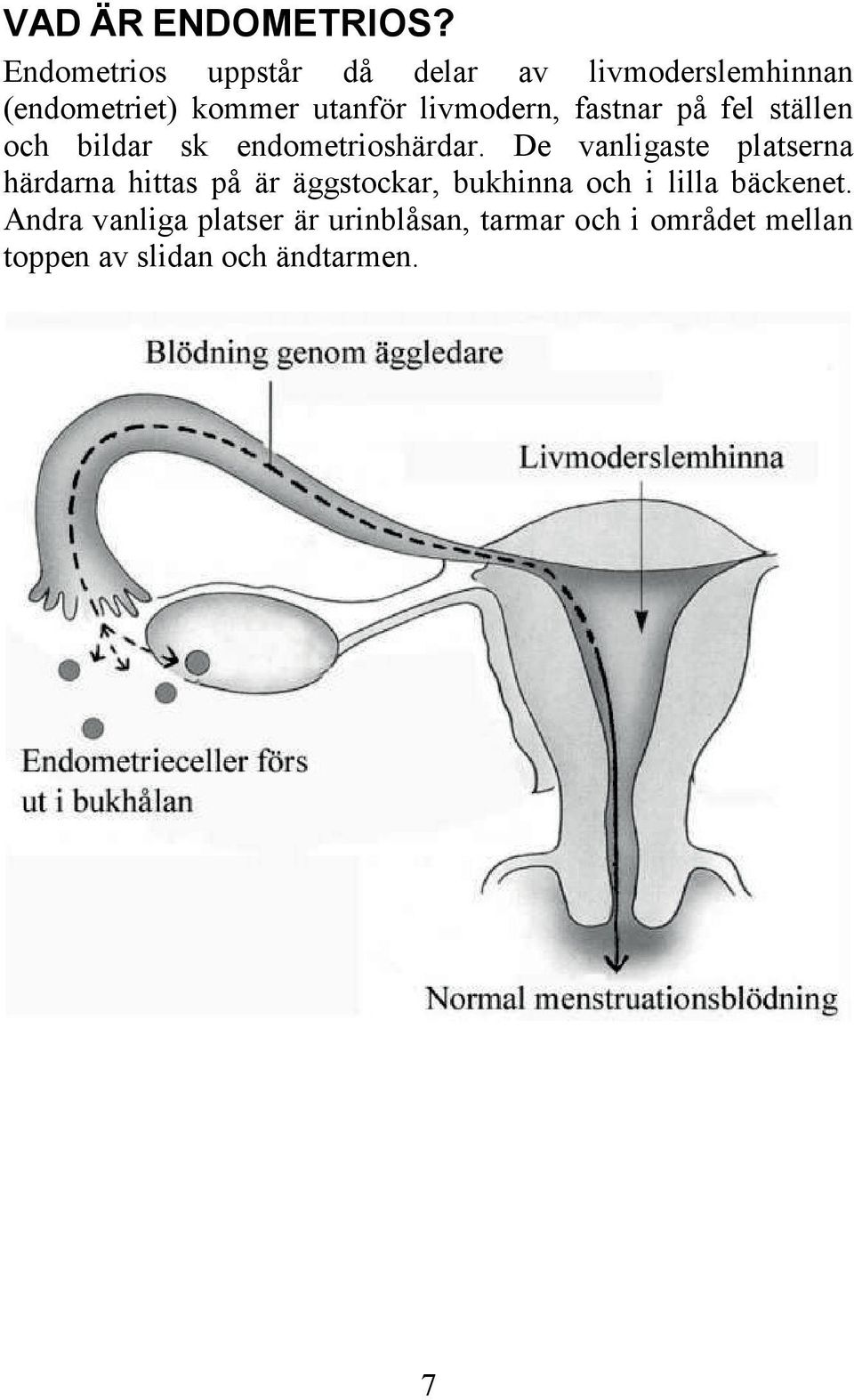 livmodern, fastnar på fel ställen och bildar sk endometrioshärdar.