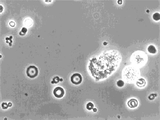 Acantocyter = renal hematuri Kornig cylinder