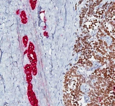 A B C D Figur 8. En jämförelse mellan hematoxylin - eosin färgning som används vid rutinfärgning och det slutgiltiga protokollet för immunohistokemisk färgning med SIX1 och CKAE 1/3 på Wilms tumör.