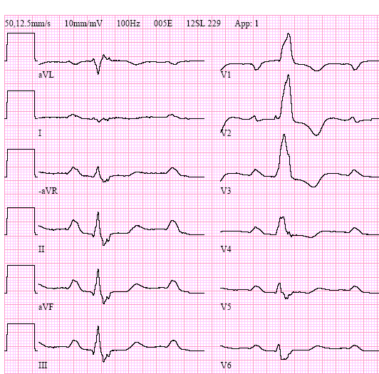 EKG högergrenblock, QRS