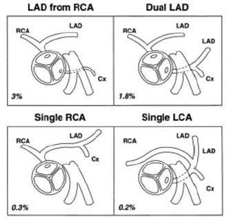 Associerade lesioner Pulmonalisklaff vanligen bicuspid, förtjockad, stenotisk Extremfall Pulmonalisatresi, MAPCA kärl DORV