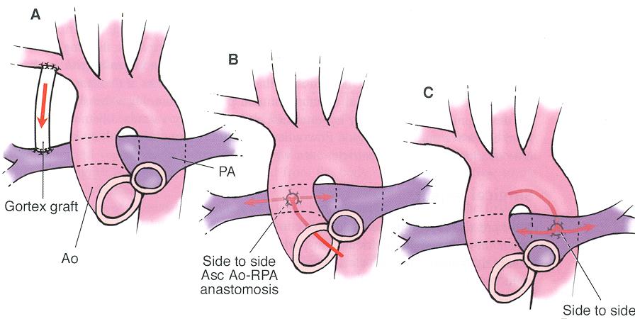 Pallierande shuntar BT shunt Waterston shunt Pulmonell hypertension (för stor