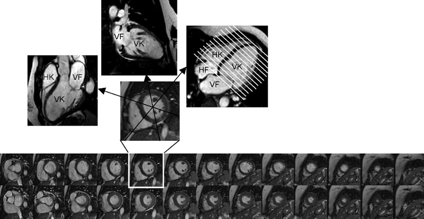 Figur 3. Längsaxel- och kortaxelbilder för funktionsbedömning av hjärtat. De bilder som visas är stillbilder från rörliga filmsekvenser med cirka 30 bilder genom hjärtcykeln.