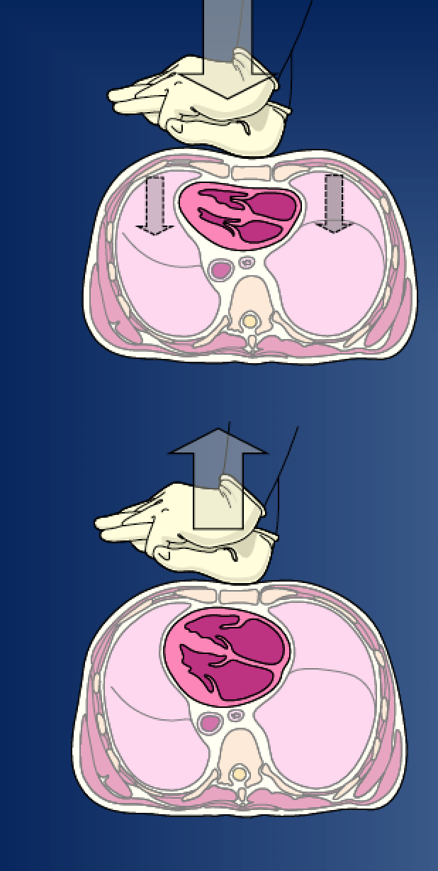 Behandling - hjärtlungräddning KOMPRESSION Öka trycket i thorax Blod ut i