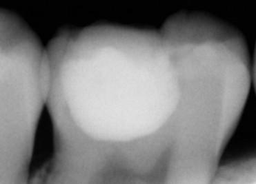 hf-gpa Infekterat dentin Affektera t dentin Affekterat dentin Materialen är pulpavänliga, och sparsamt med calcium-hydroxid används endast vid mycket pulpanära situation eller mikrolaesion.
