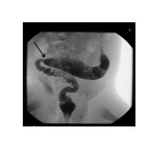 Figure 6. A contrast enema shows the transition zone (arrow) in the sigmoid colon. The diagnosis is confirmed by rectal suction biopsies.