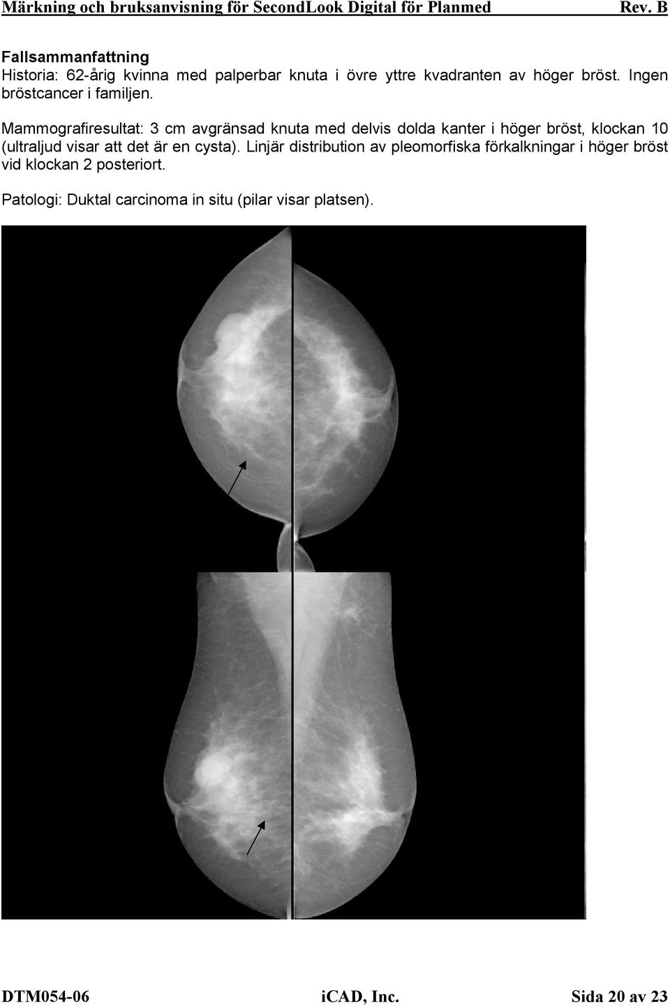 Mammografiresultat: 3 cm avgränsad knuta med delvis dolda kanter i höger bröst, klockan 10 (ultraljud visar att