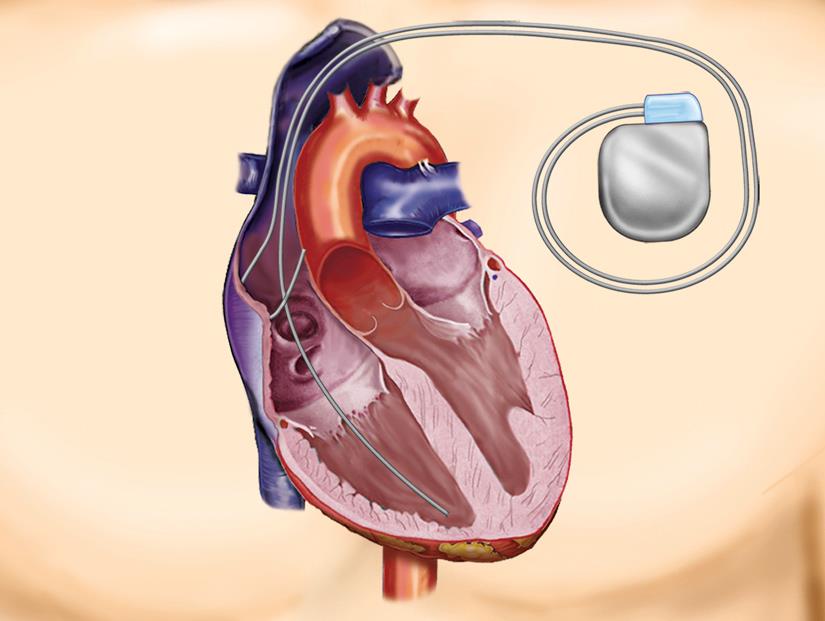 Pacemaker Pris 3 300-5 600 kr