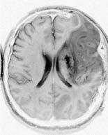 Bildkontraster: känn till mönstren -viktning viktad bild viktad med kontrast T2 viktad bild lång = låg signal (grått eller svart) ex vatten, ödem, infarkt, inflammation, tumör Ger relativt lite