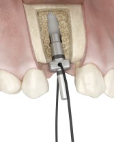 Placering av implantat steg för steg: OsseoSpeed EV Nedan visas ett protokoll steg-för-steg för preparation och installation av en OsseoSpeed EV 4.2 S, 13 mm. Obs!