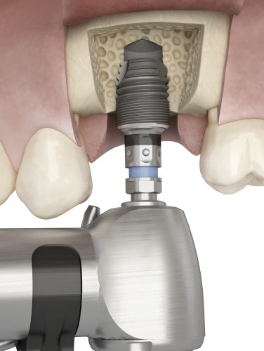 6 mm Cortical Drill EV Implant Depth Gauge EV Installation Avsluta sätespreparationen genom att borra till den marginala änden av djupmarkeringen.