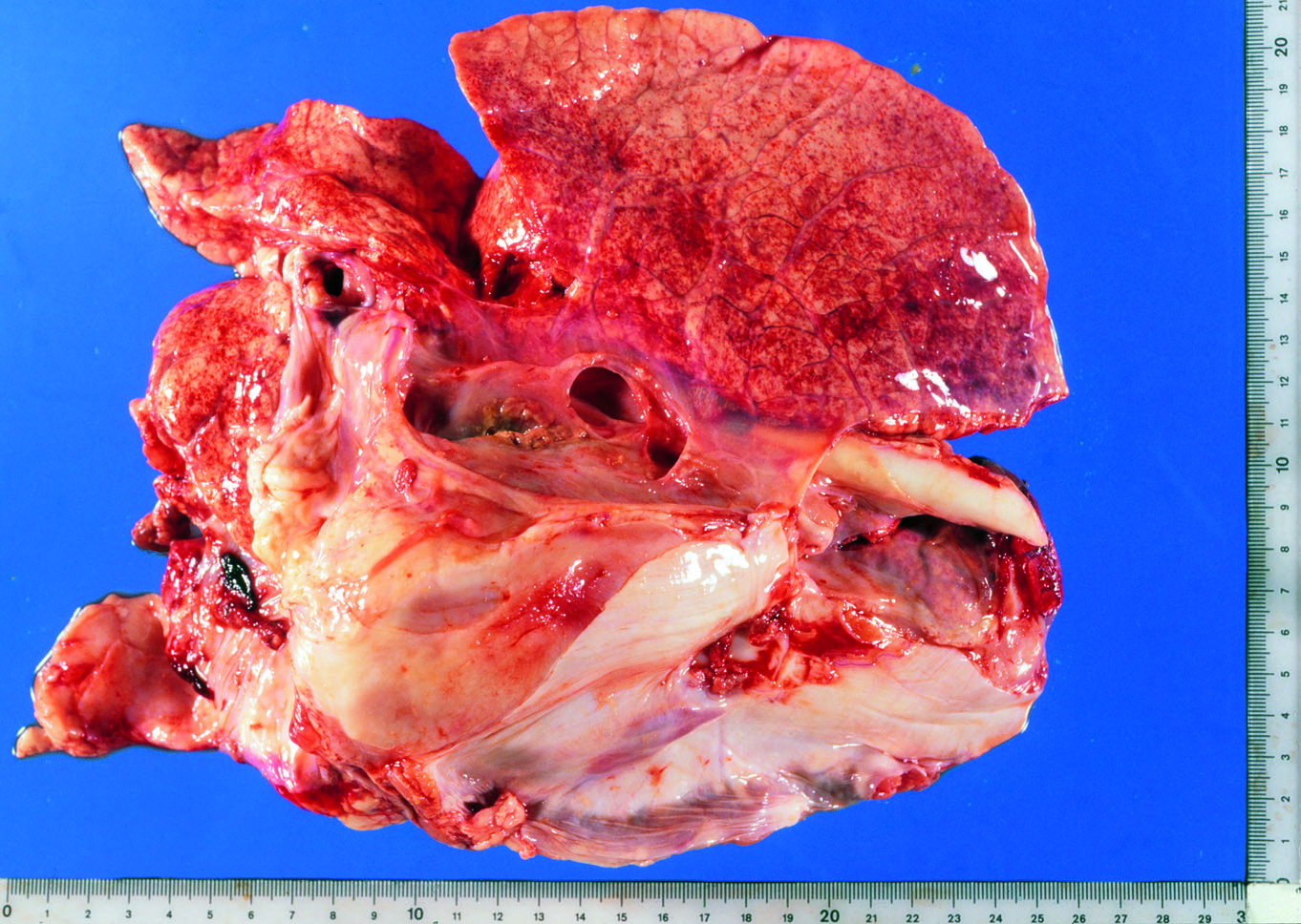FIGUR 2. Förändringar i brösthålan hos en gris som dött i akut aktinobacillos.