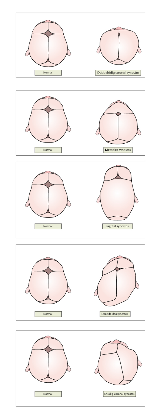 Övriga orsaker till skallasymmetri eller torticollis KRANIOSYNOSTOS Kraniosynostos innebär en för tidig slutning av skallens tillväxtsömmar, s.k. prematur kraniosynostos.