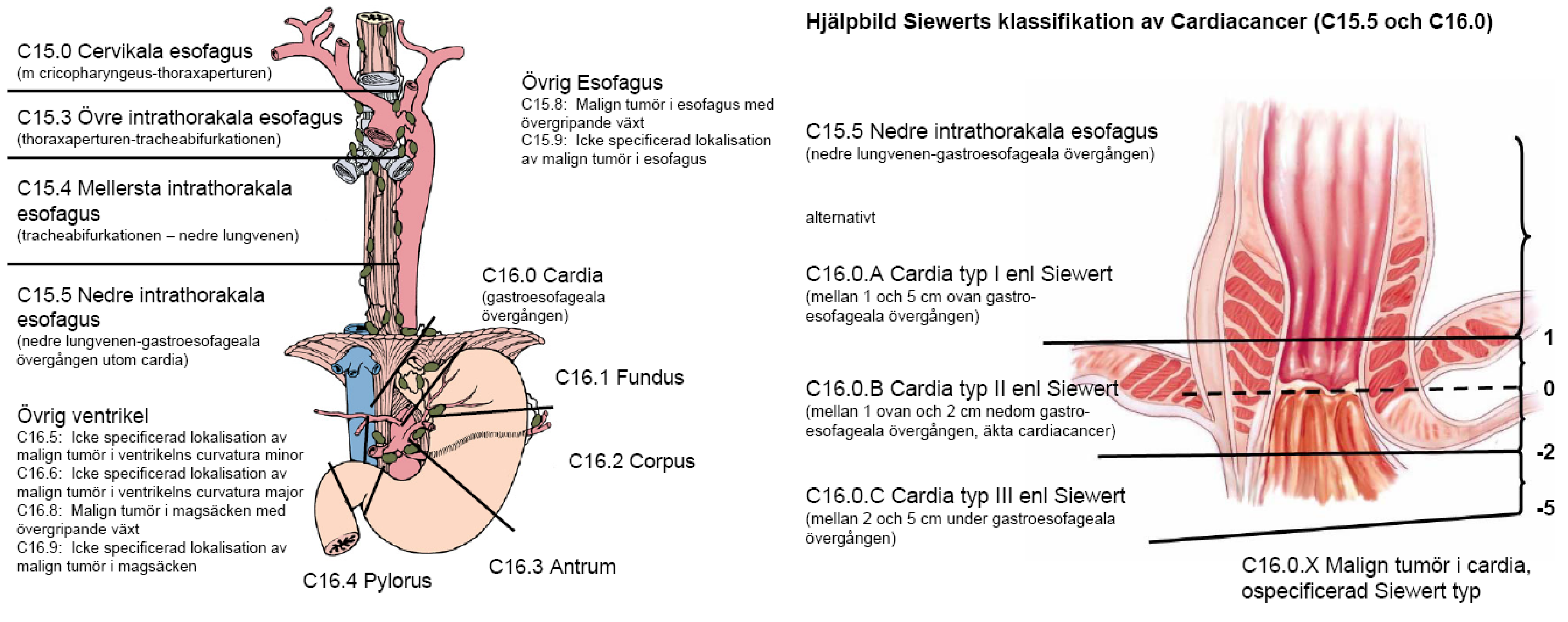 Tumörlokal Den ökande incidensen av tumörer i distala esofagus och i gastroesofageala övergången har skärpt medvetenheten i diagnostiken.