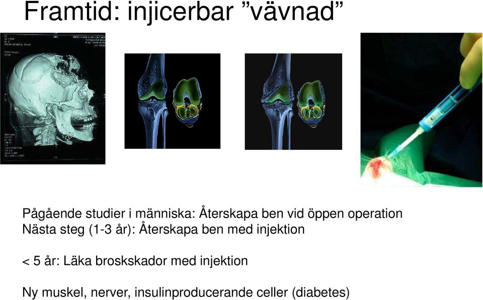 Återskapa ben med injektion < 5 år: Läka broskskador med