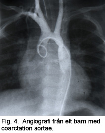 Craffoord opererade det första fallet i världen av coartatio aortae Fig. 4. Angiografi från ett barn med coarctation aortae.