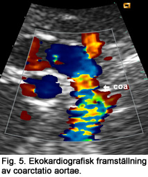 ..och omvärlden kom ifatt Stockholm och Sverige.. För de mest komplexa medfödda hjärtmissbildningarna har nya tekniker som datortomografi och MR blivit viktiga komplement (Fig. 6).