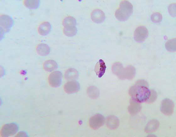 3.2 Laboratory diagnosis of malaria by conventional peripheral blood smear examination with Quantitative Buffy Coat (QBC) and Rapid Diagnostic Tests (RDT) - A comparative study (Sandhya et al, 2012).