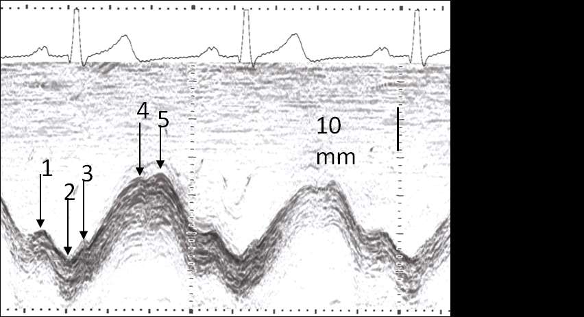 Sida 2 av 9 rörelsen kan AV-plansamplituder mätas i lateralvägg, septum och höger kammares fria vägg från apikal fyrkammarbild och anterior vägg och posterior vägg i apikal två kammarbild.